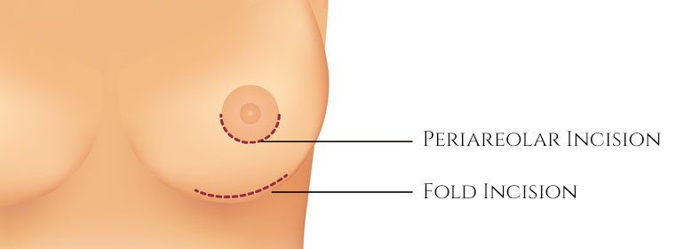 Breast Augmentation Incision Options