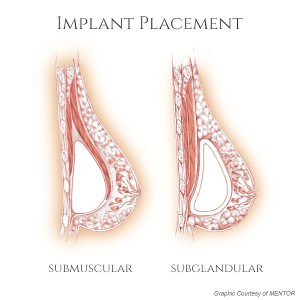 The Villages breast augmentation implant placement