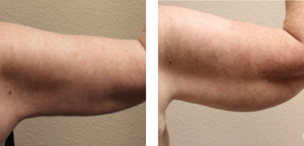 Arm lift Before & After Image