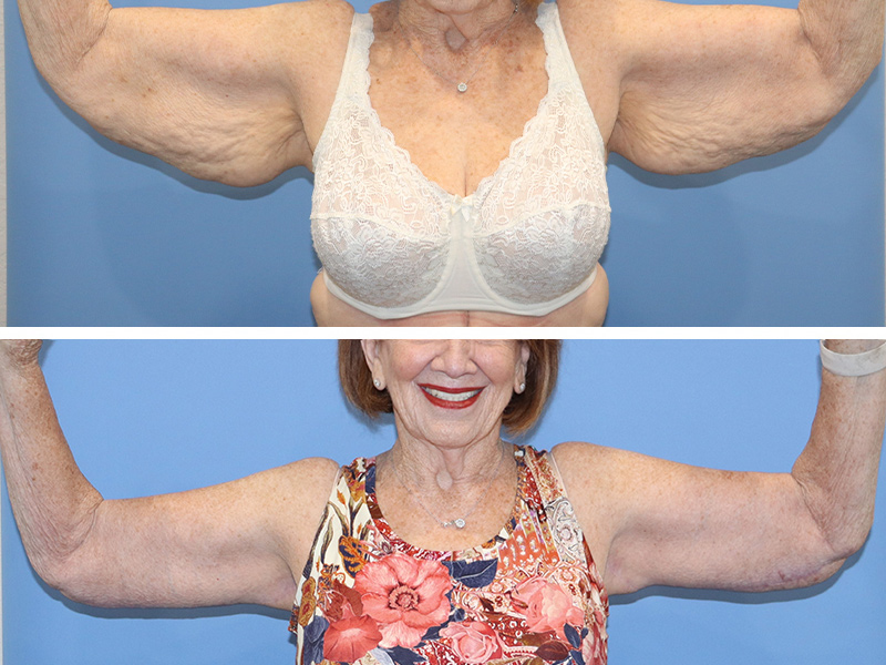 Arm lift Before & After Image