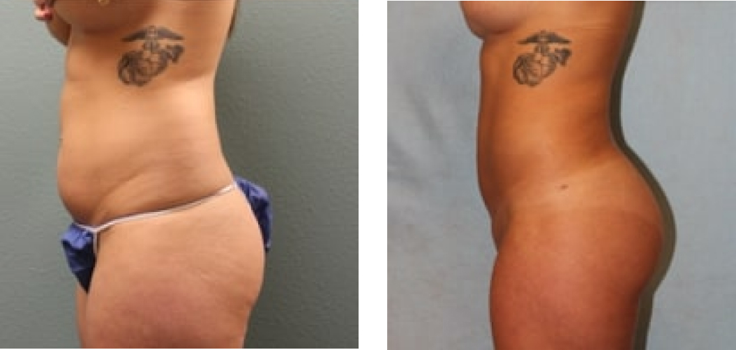 Liposuction Before & After Image