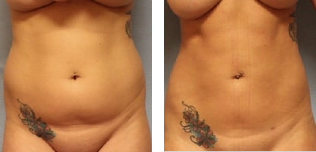 Liposuction Before & After Image