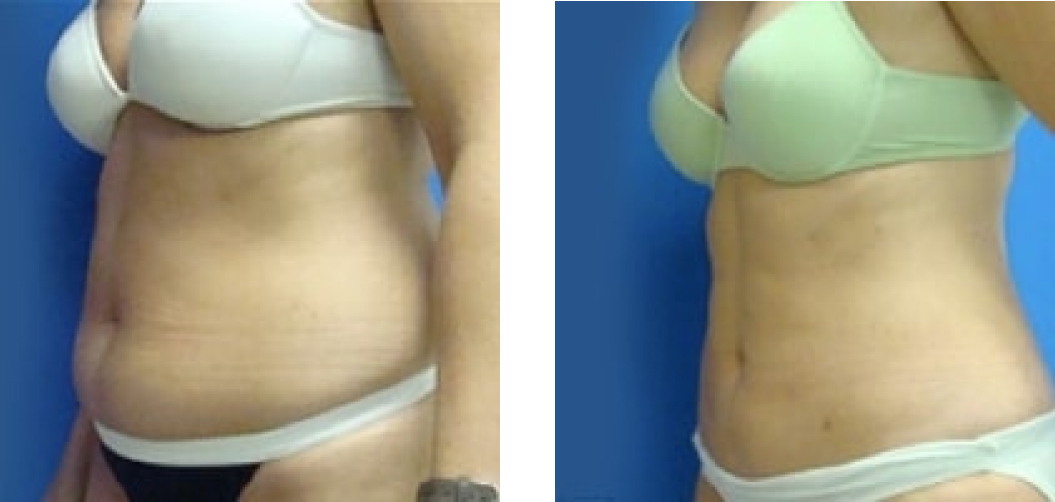 Liposuction Before & After Image