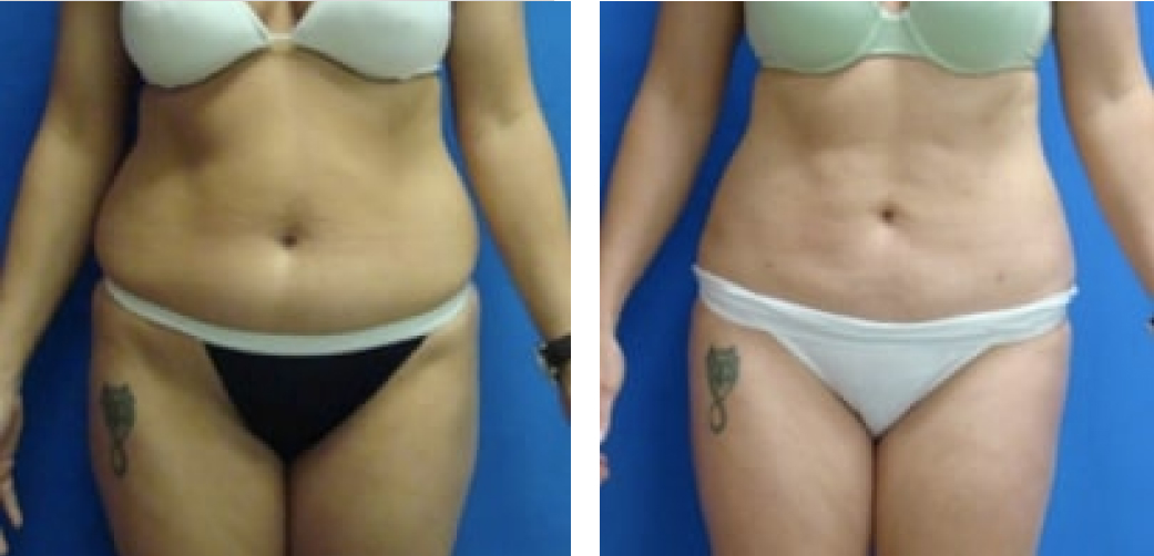 Liposuction Before & After Image