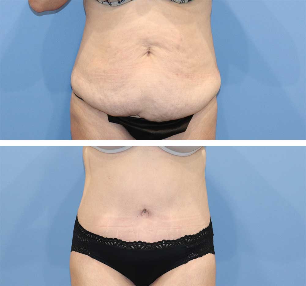 Tummy Tuck Before & After Image