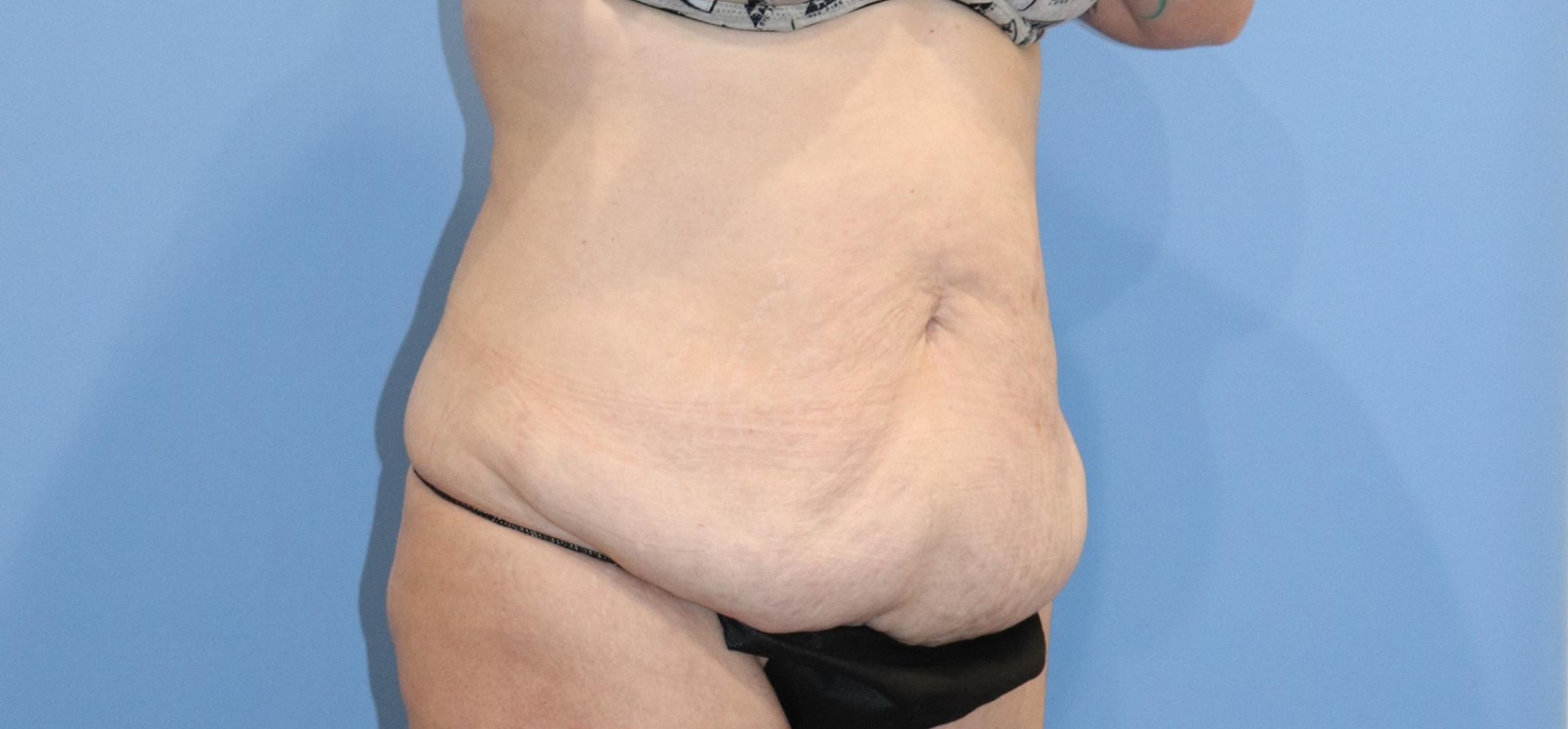 Tummy Tuck Before & After Image