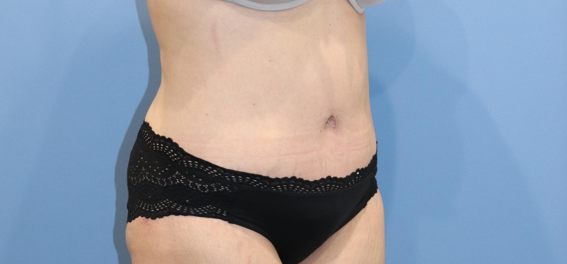 Tummy Tuck Before & After Image