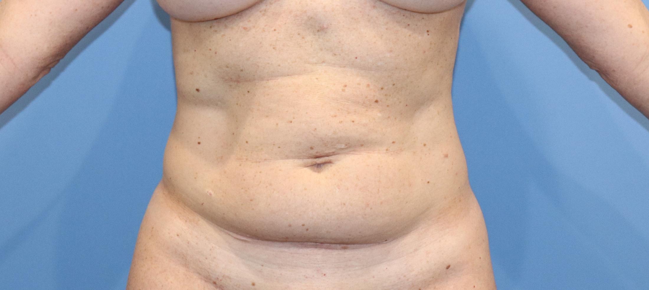 Tummy Tuck Before & After Image