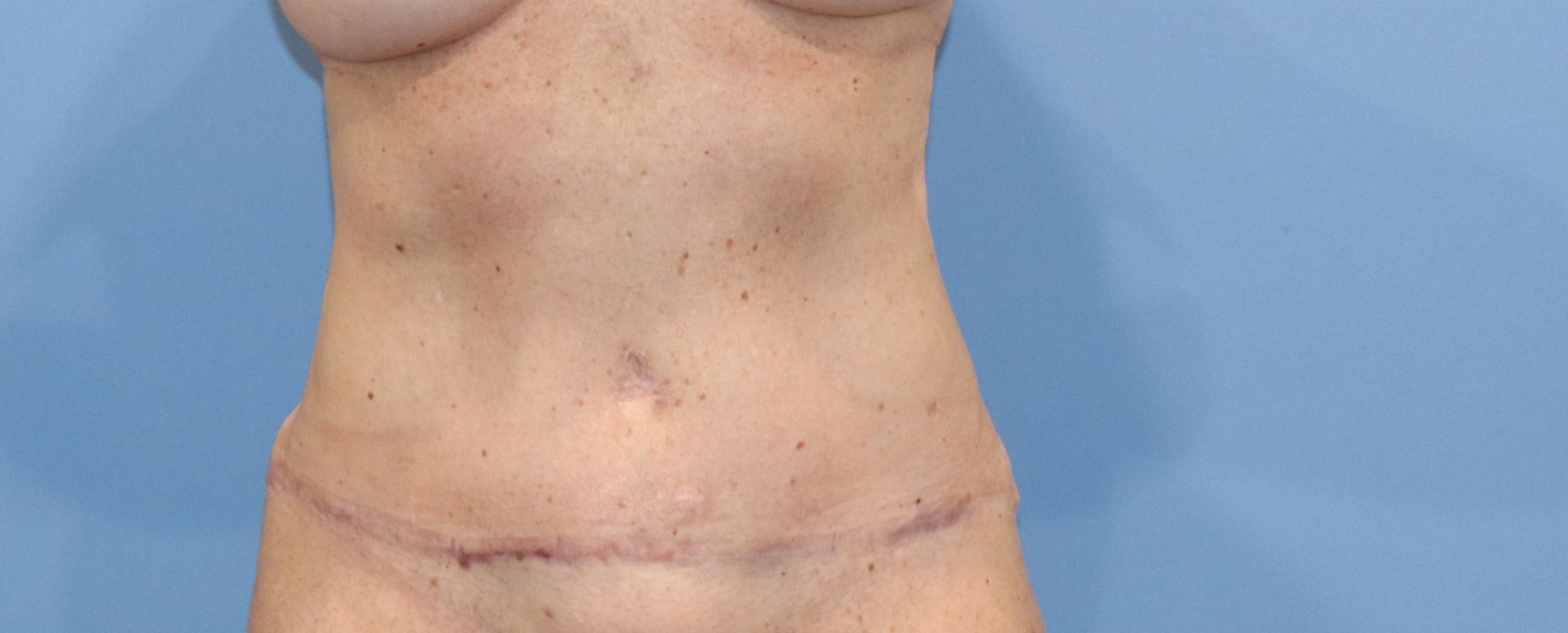 Tummy Tuck Before & After Image