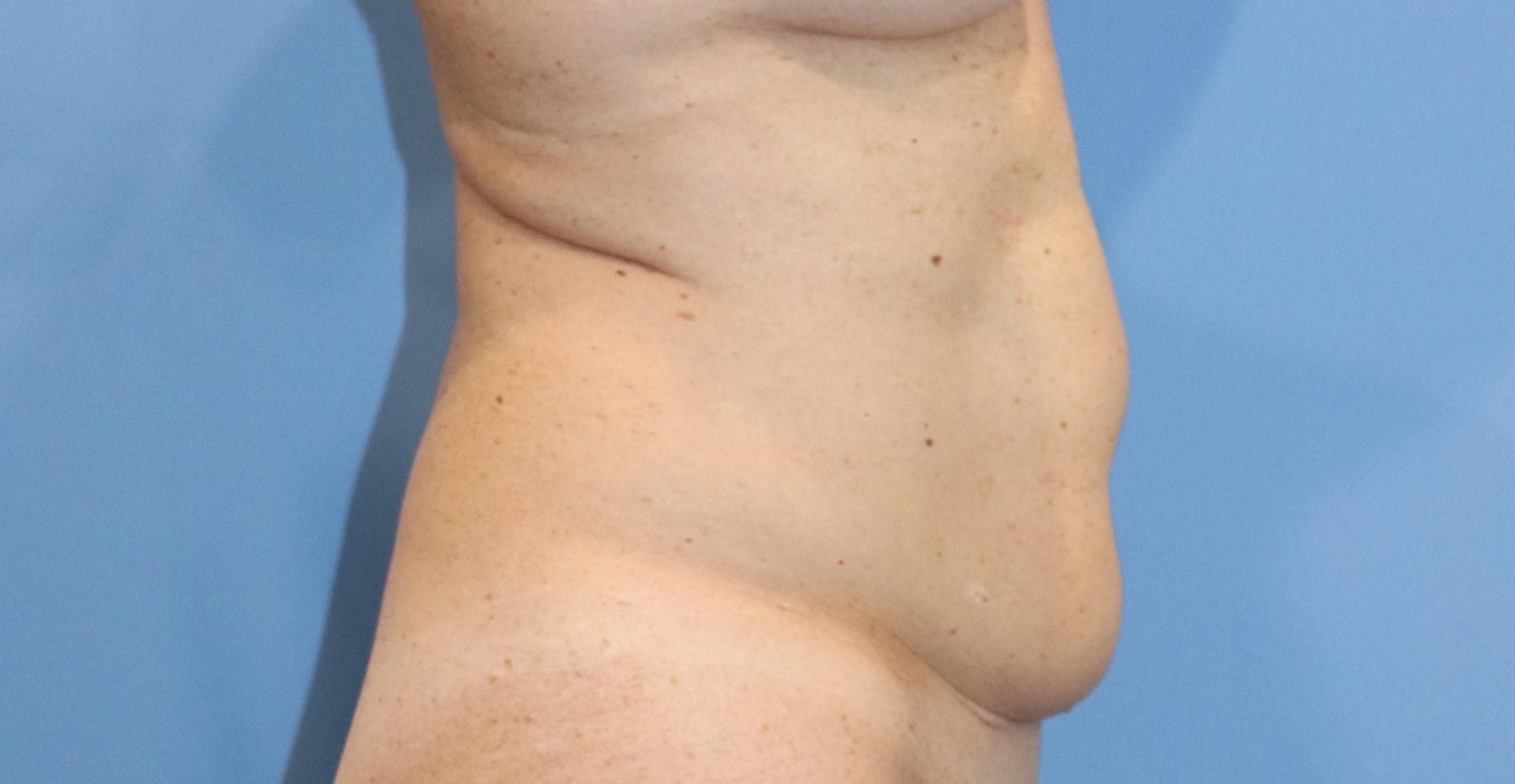 Tummy Tuck Before & After Image