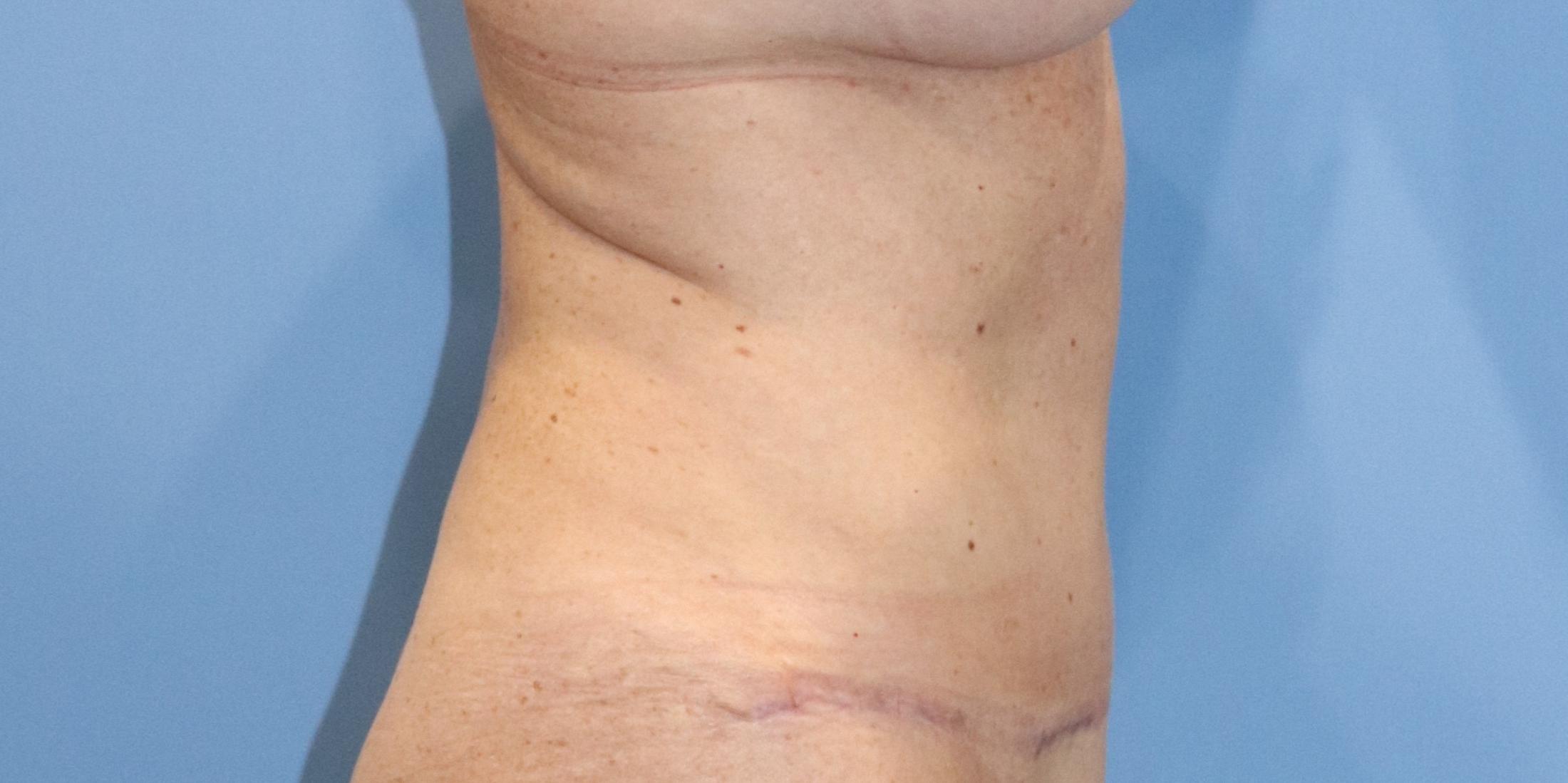 Tummy Tuck Before & After Image