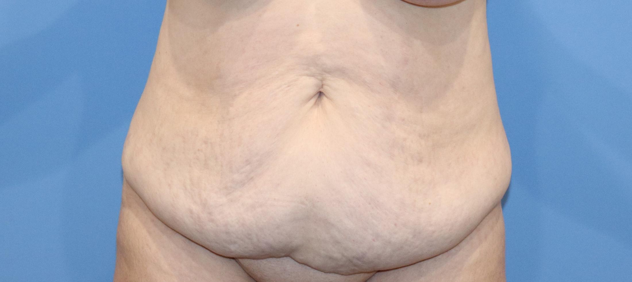 Tummy Tuck Before & After Image