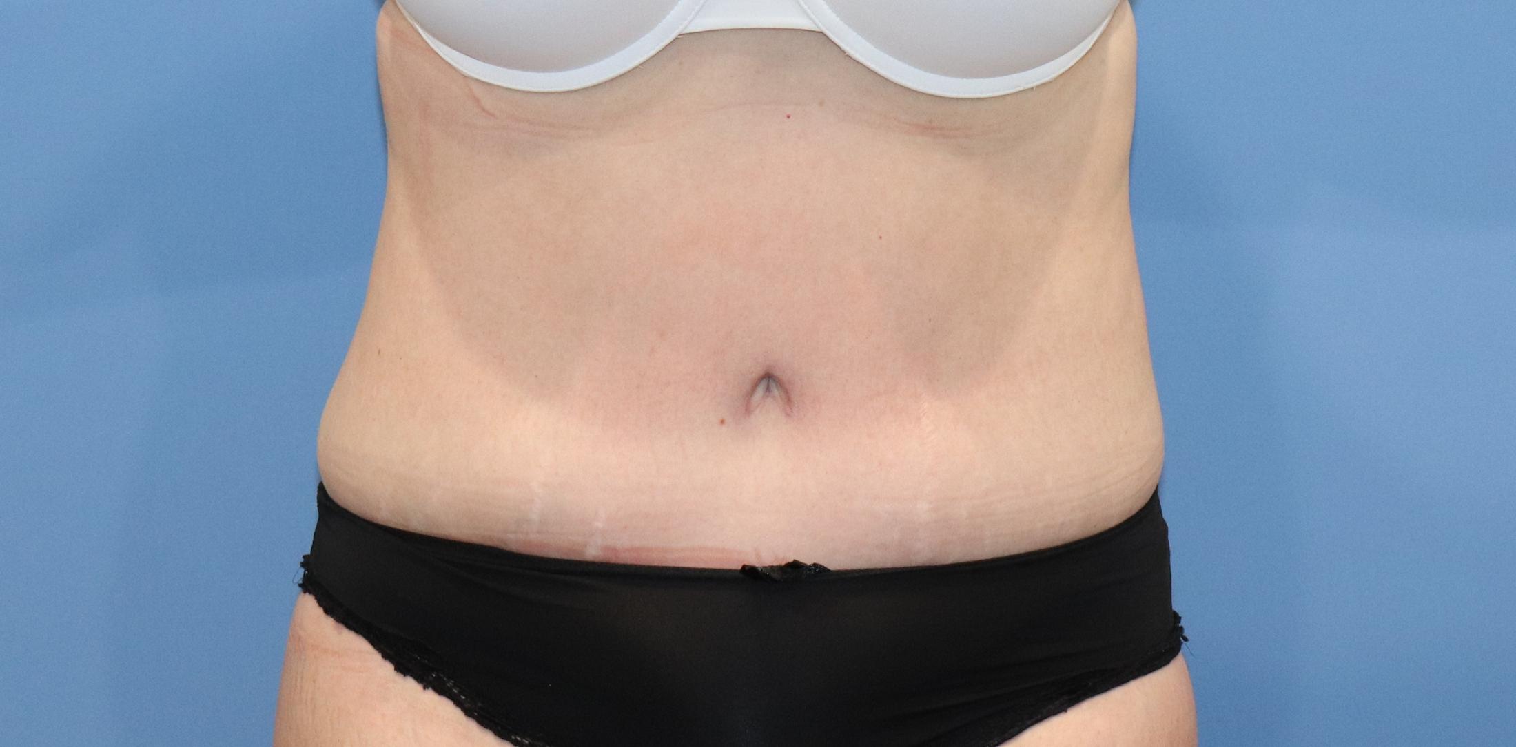 Tummy Tuck Before & After Image