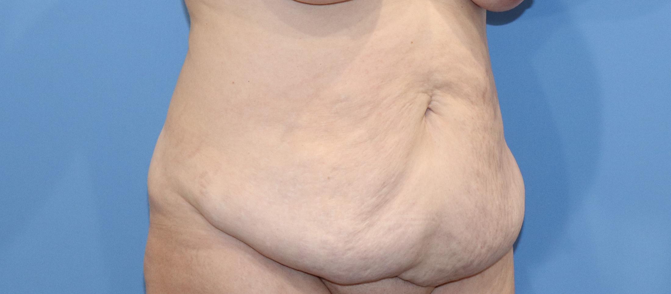 Tummy Tuck Before & After Image