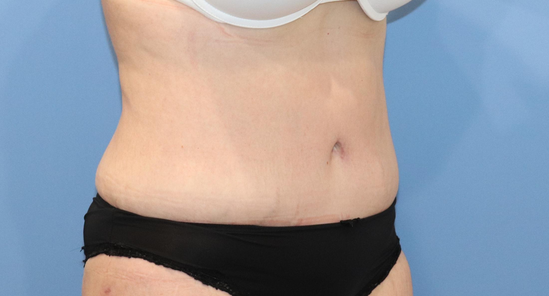 Tummy Tuck Before & After Image