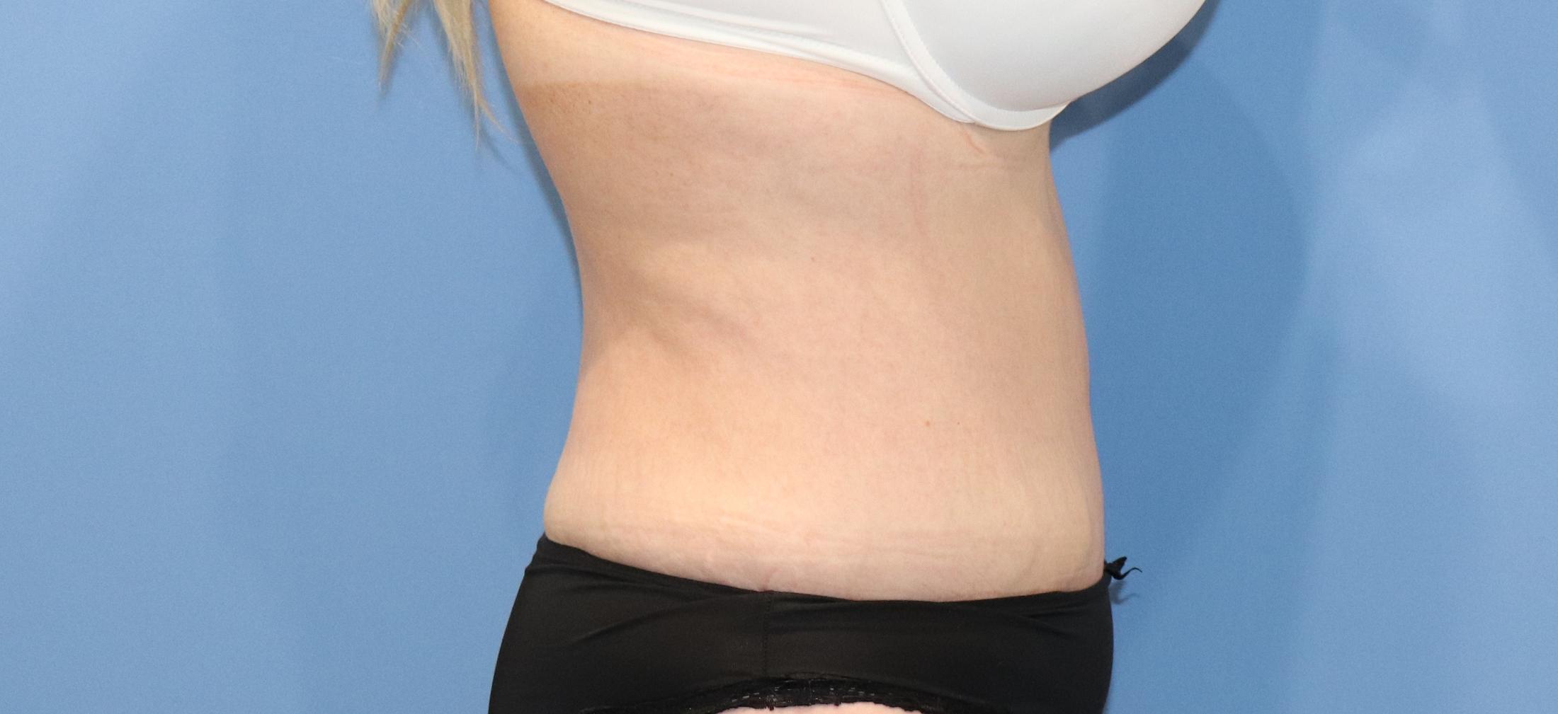 Tummy Tuck Before & After Image