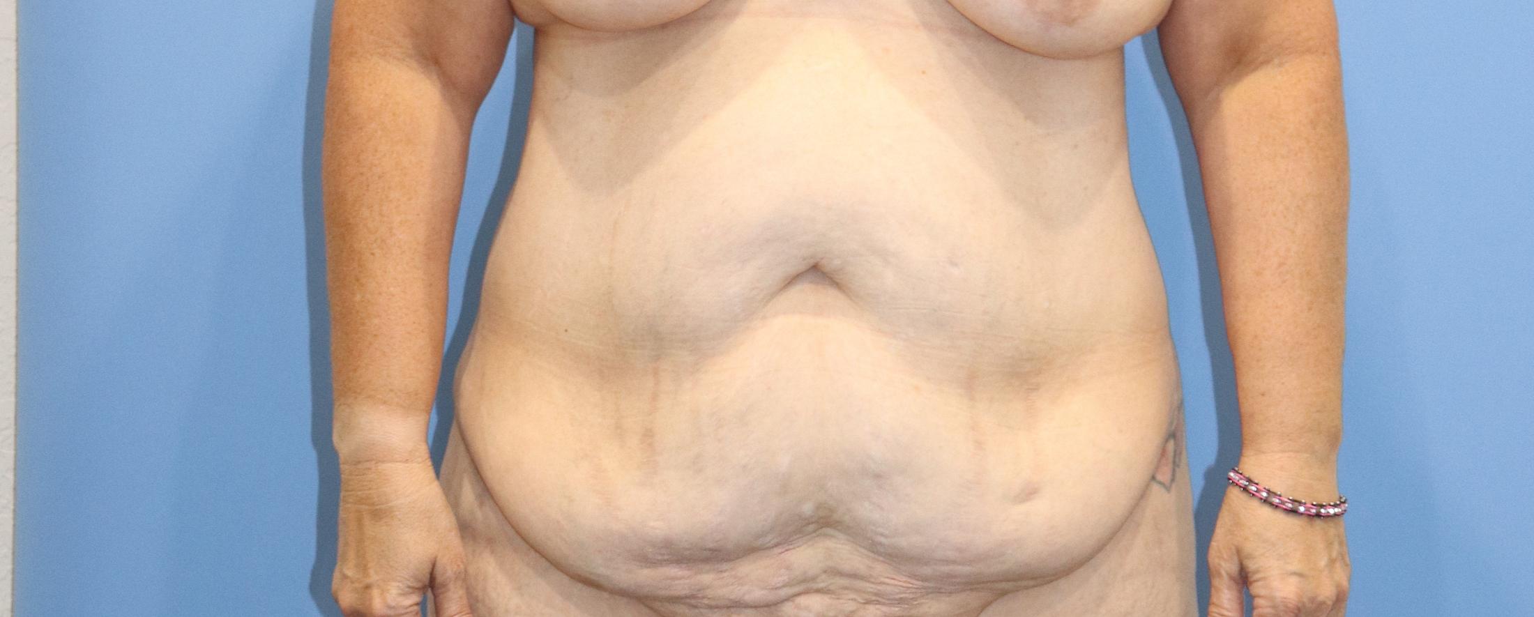 Tummy Tuck Before & After Image