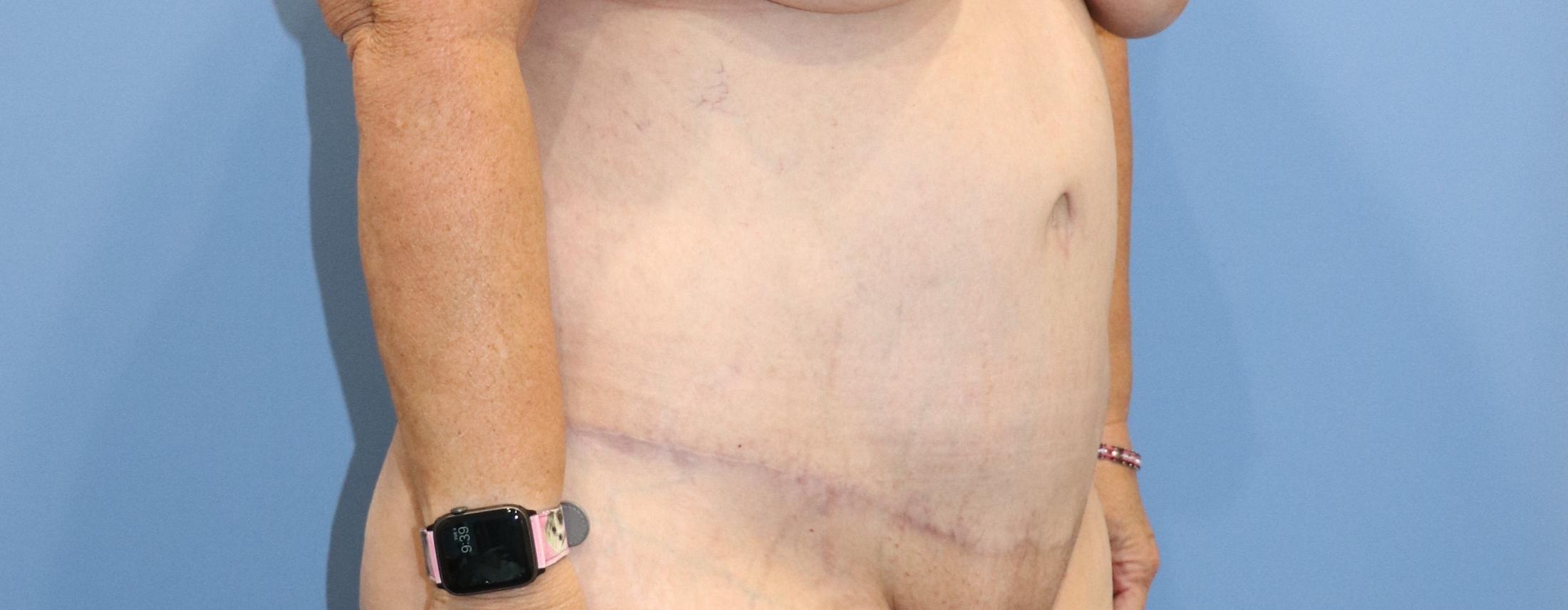 Tummy Tuck Before & After Image