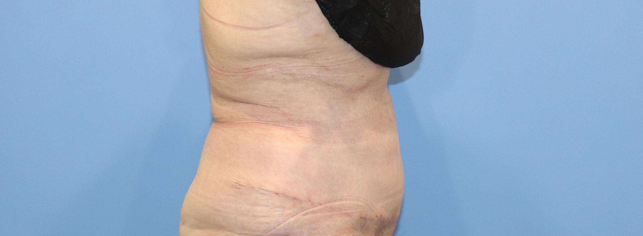 Tummy Tuck Before & After Image