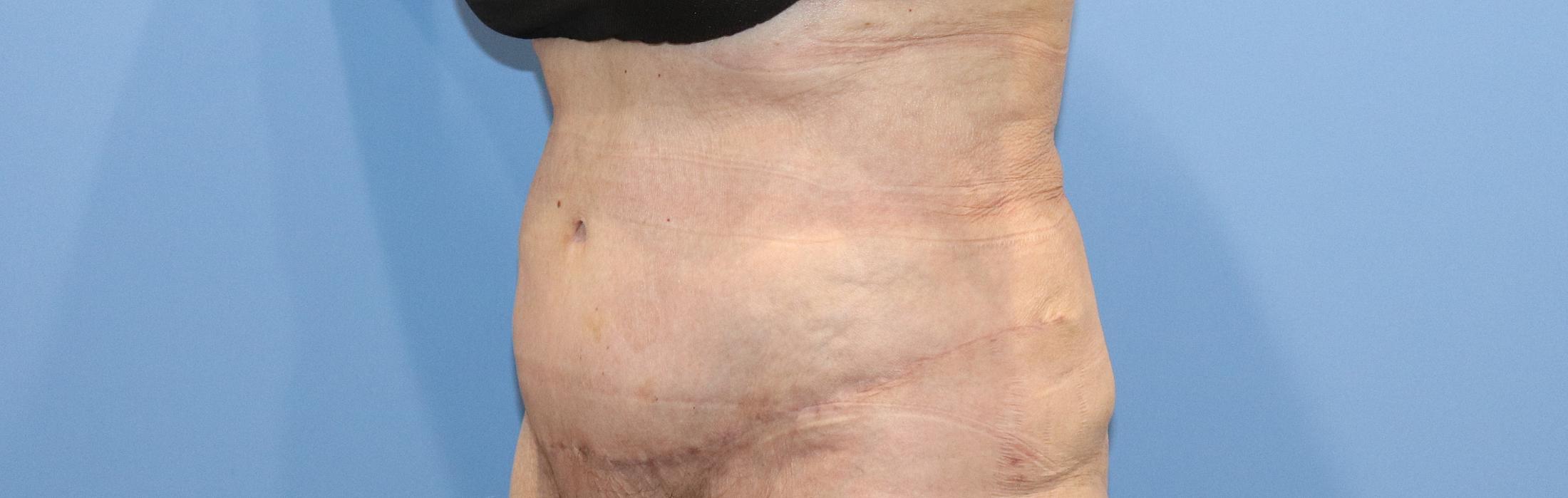 Tummy Tuck Before & After Image