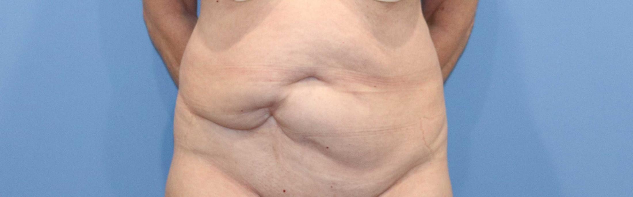 Tummy Tuck Before & After Image