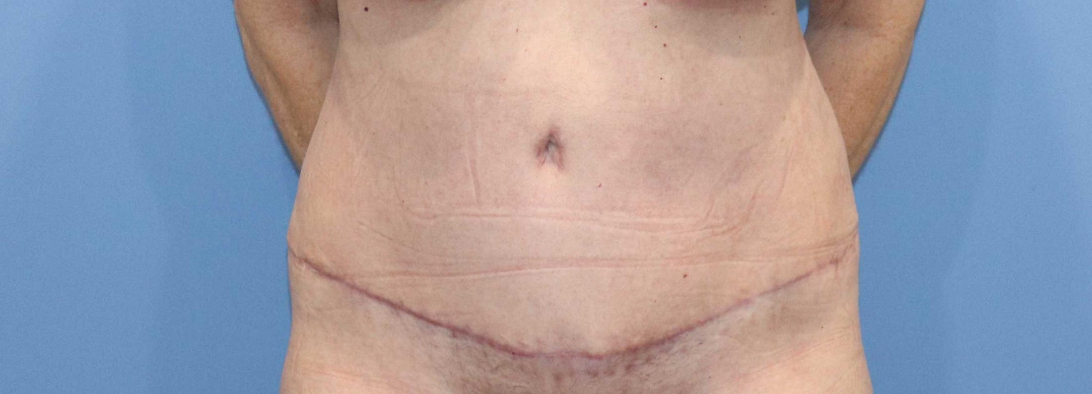 Tummy Tuck Before & After Image