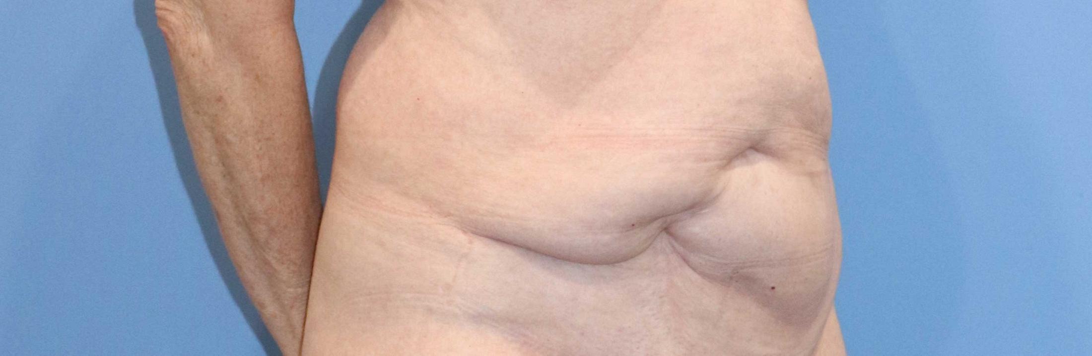 Tummy Tuck Before & After Image