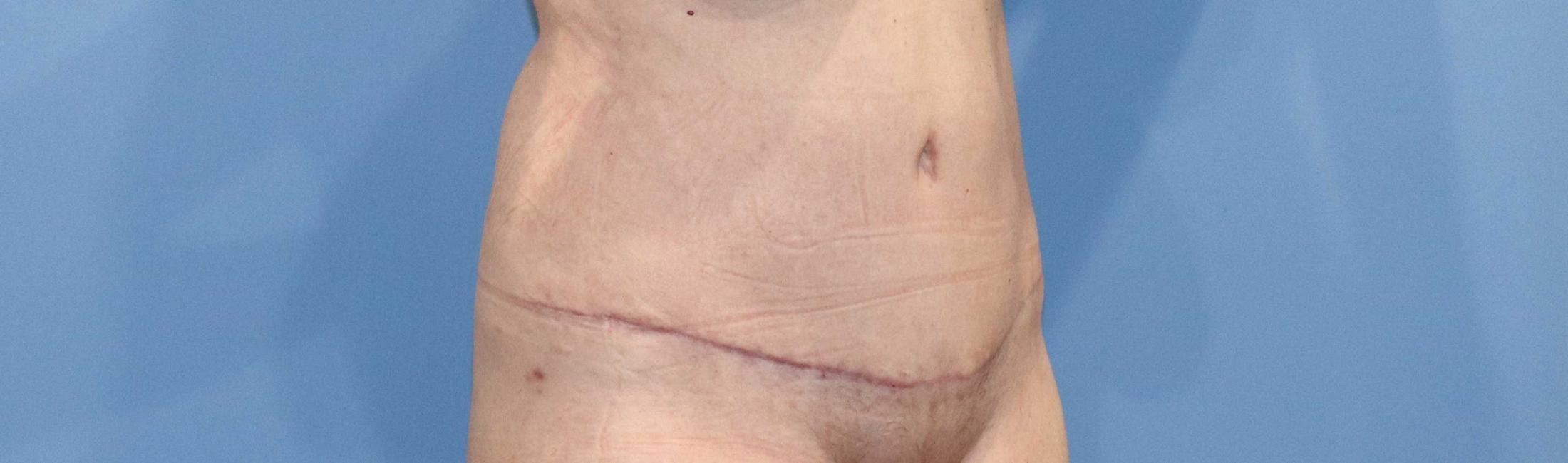 Tummy Tuck Before & After Image