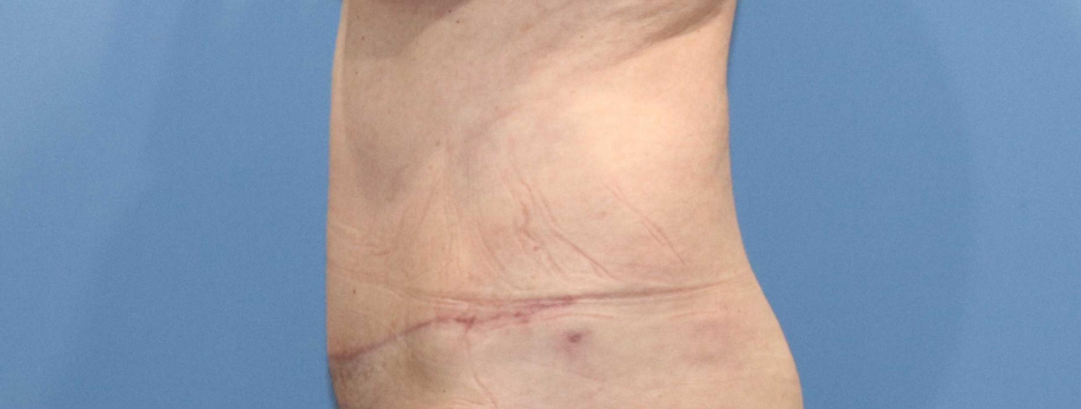 Tummy Tuck Before & After Image