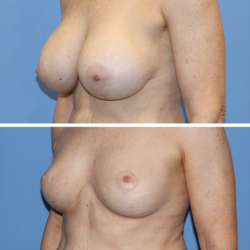 Implant Removal with Lift Before & After Image