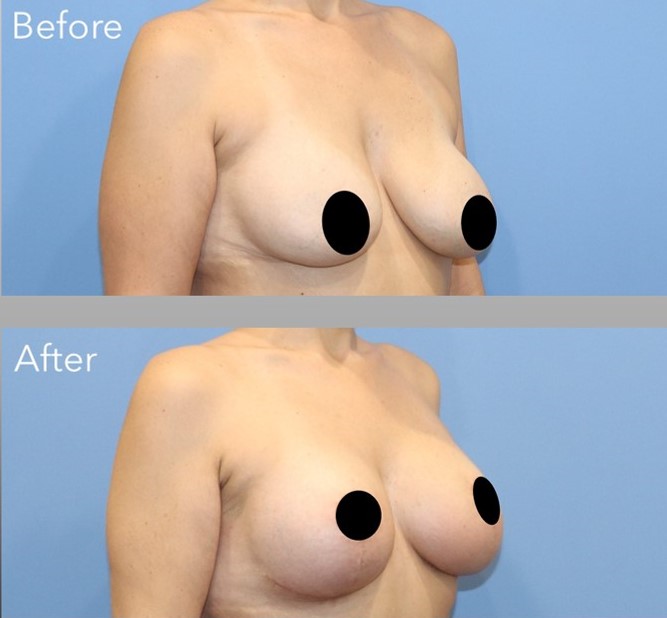 Mastopexy Before & After Image