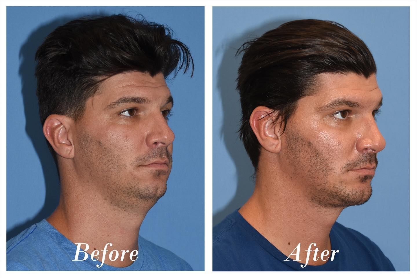 Chin Augmentation Before & After Image