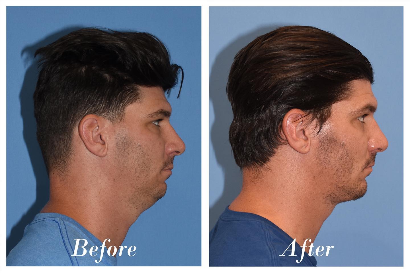 Chin Augmentation Before & After Image