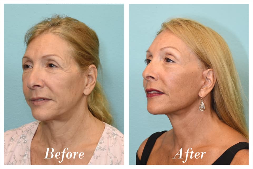 Facelift & Browlift Before & After Image