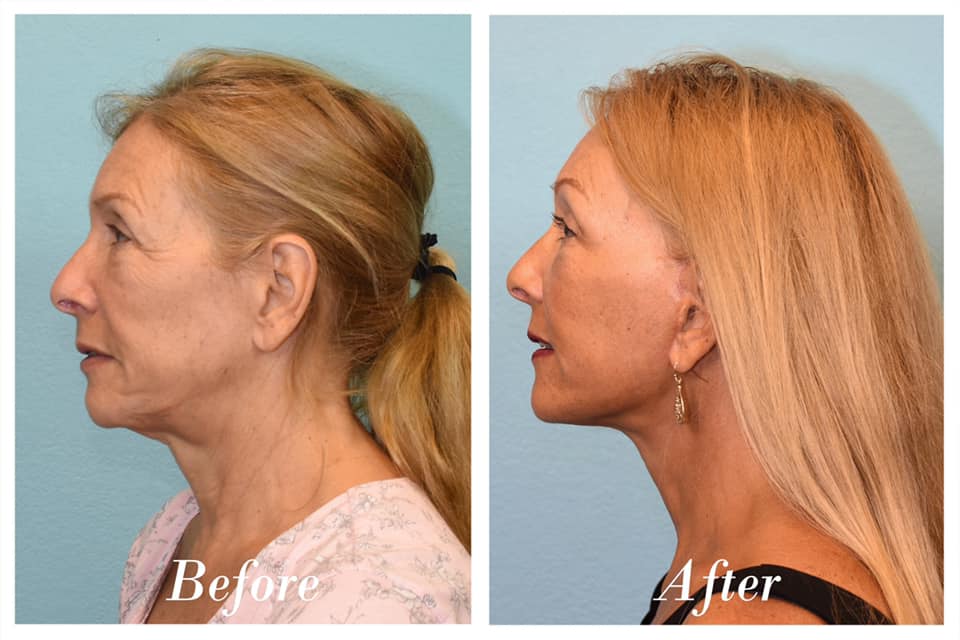 Facelift & Browlift Before & After Image