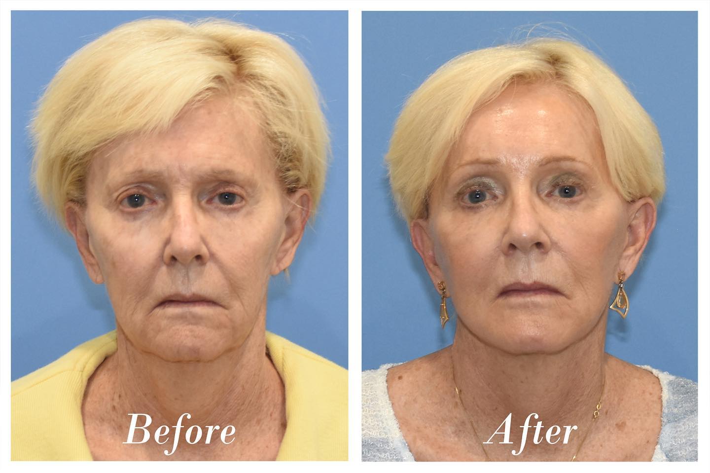 Facelift & Browlift Before & After Image