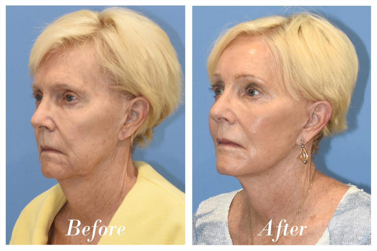 Facelift & Browlift Before & After Image