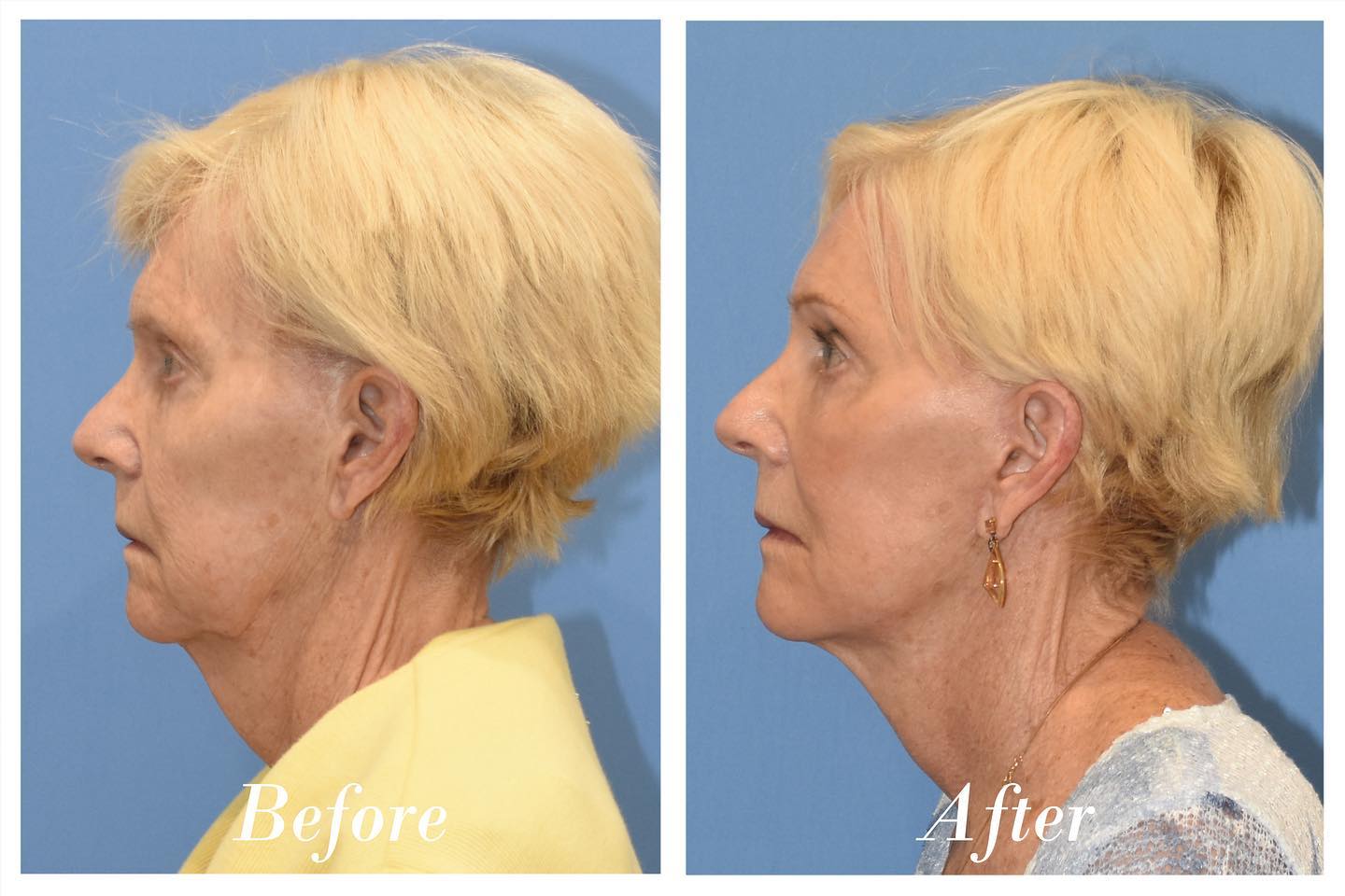 Facelift & Browlift Before & After Image