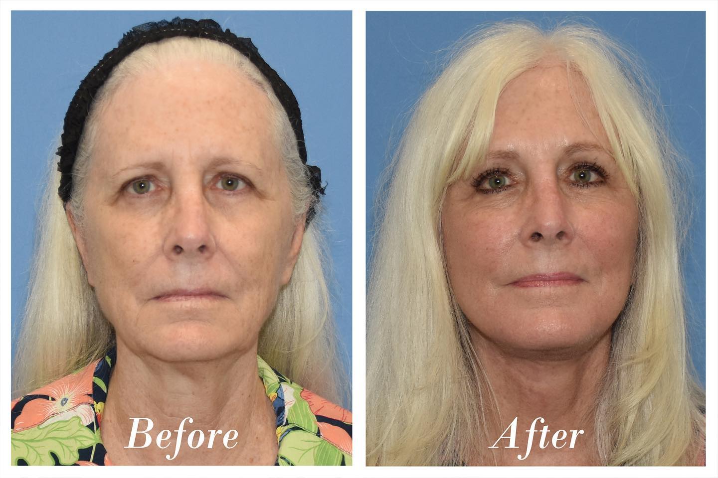 Facelift & Browlift Before & After Image