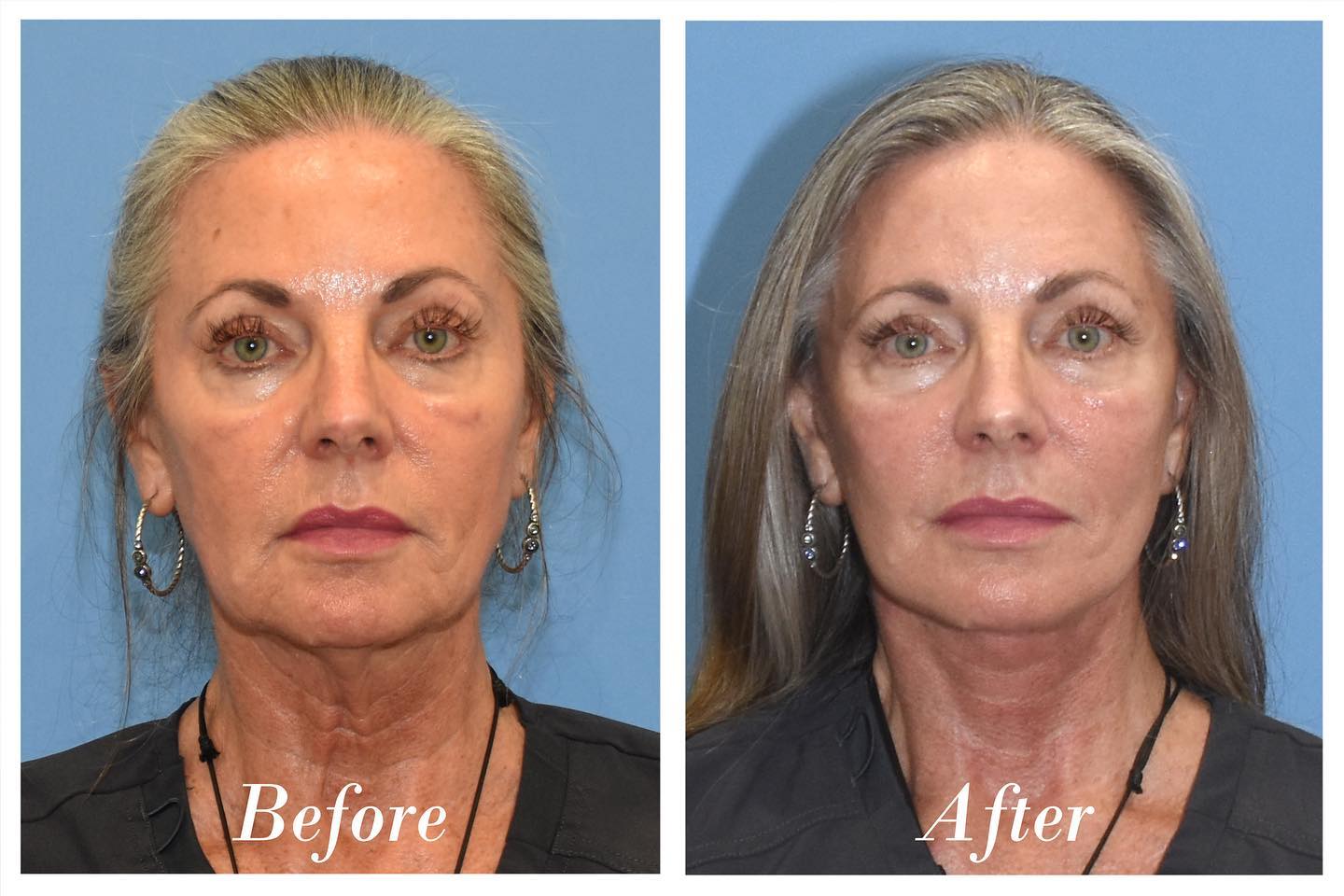 C02 Laser Before & After Image