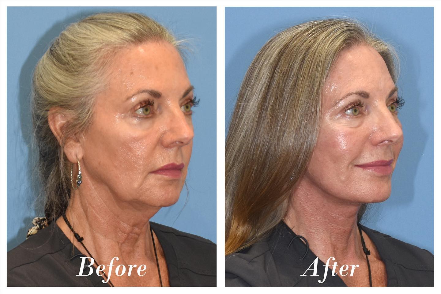 C02 Laser Before & After Image