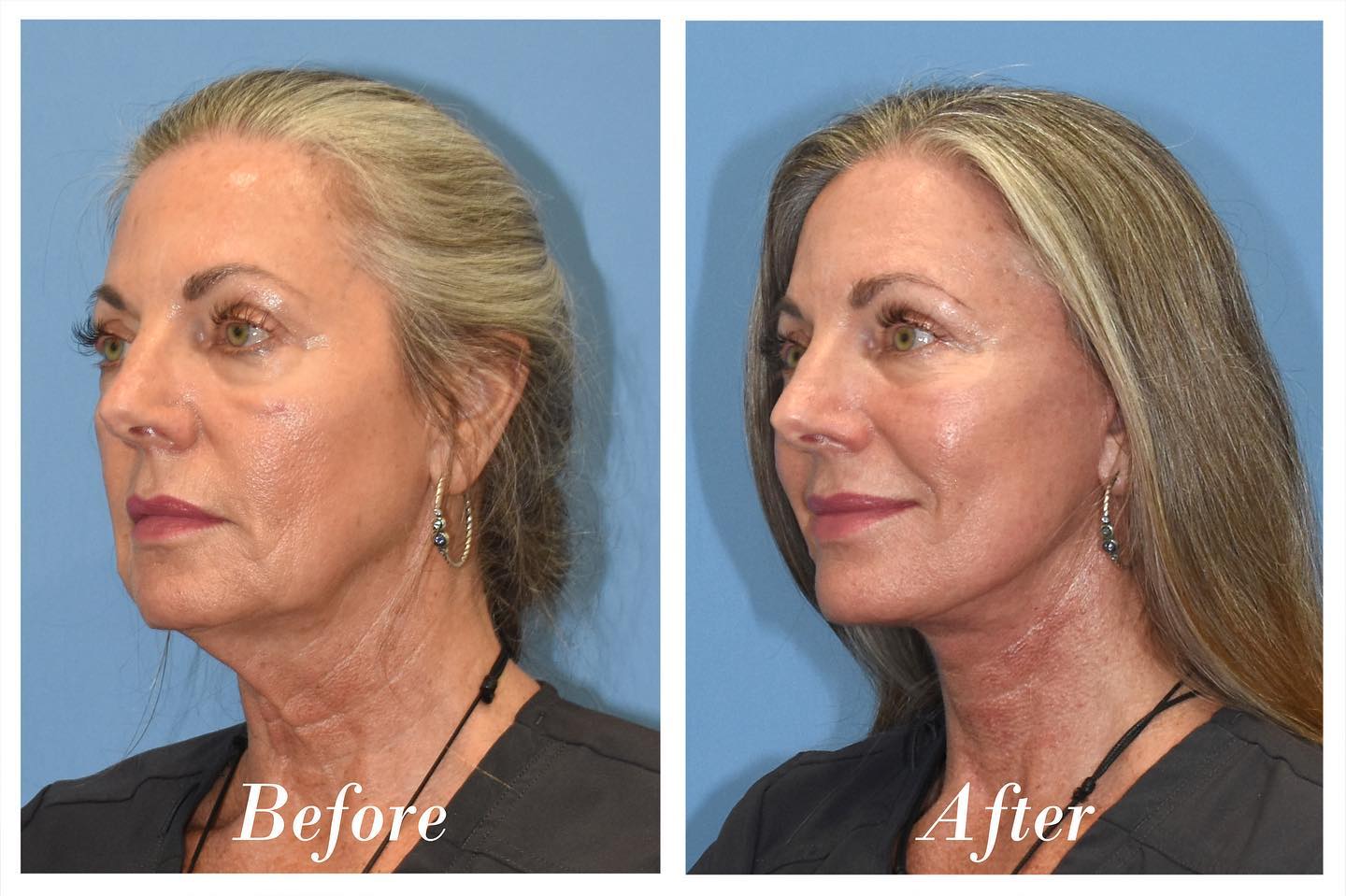 C02 Laser Before & After Image