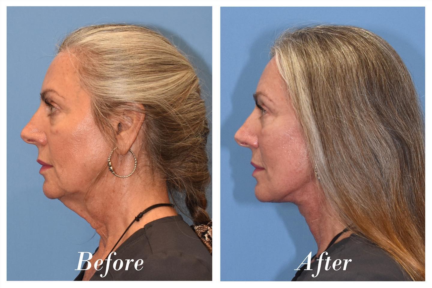 C02 Laser Before & After Image