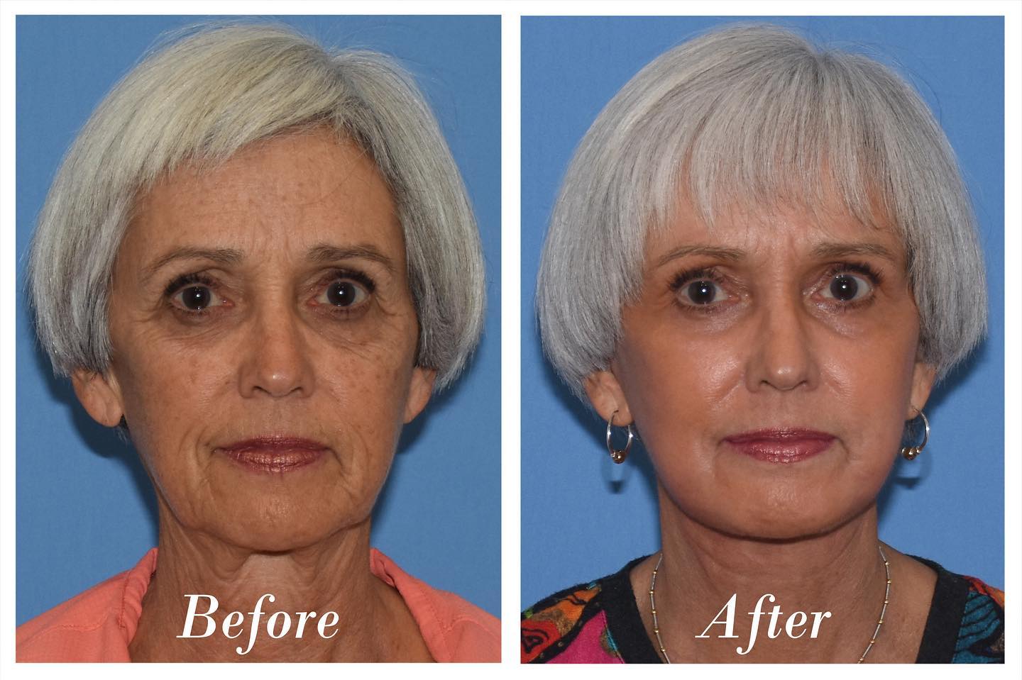 C02 Laser Before & After Image