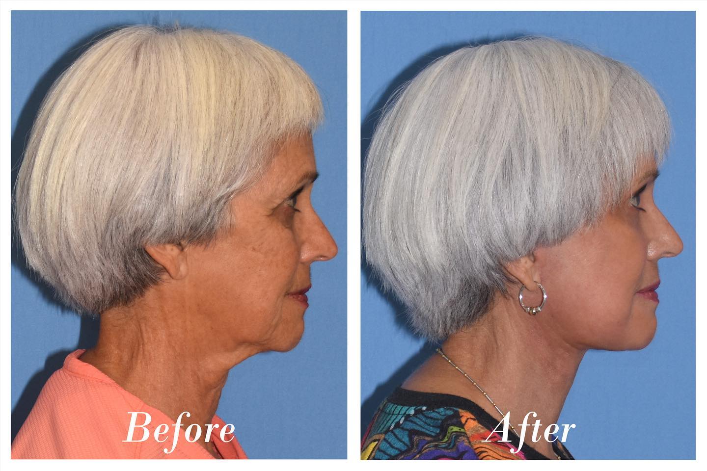 C02 Laser Before & After Image