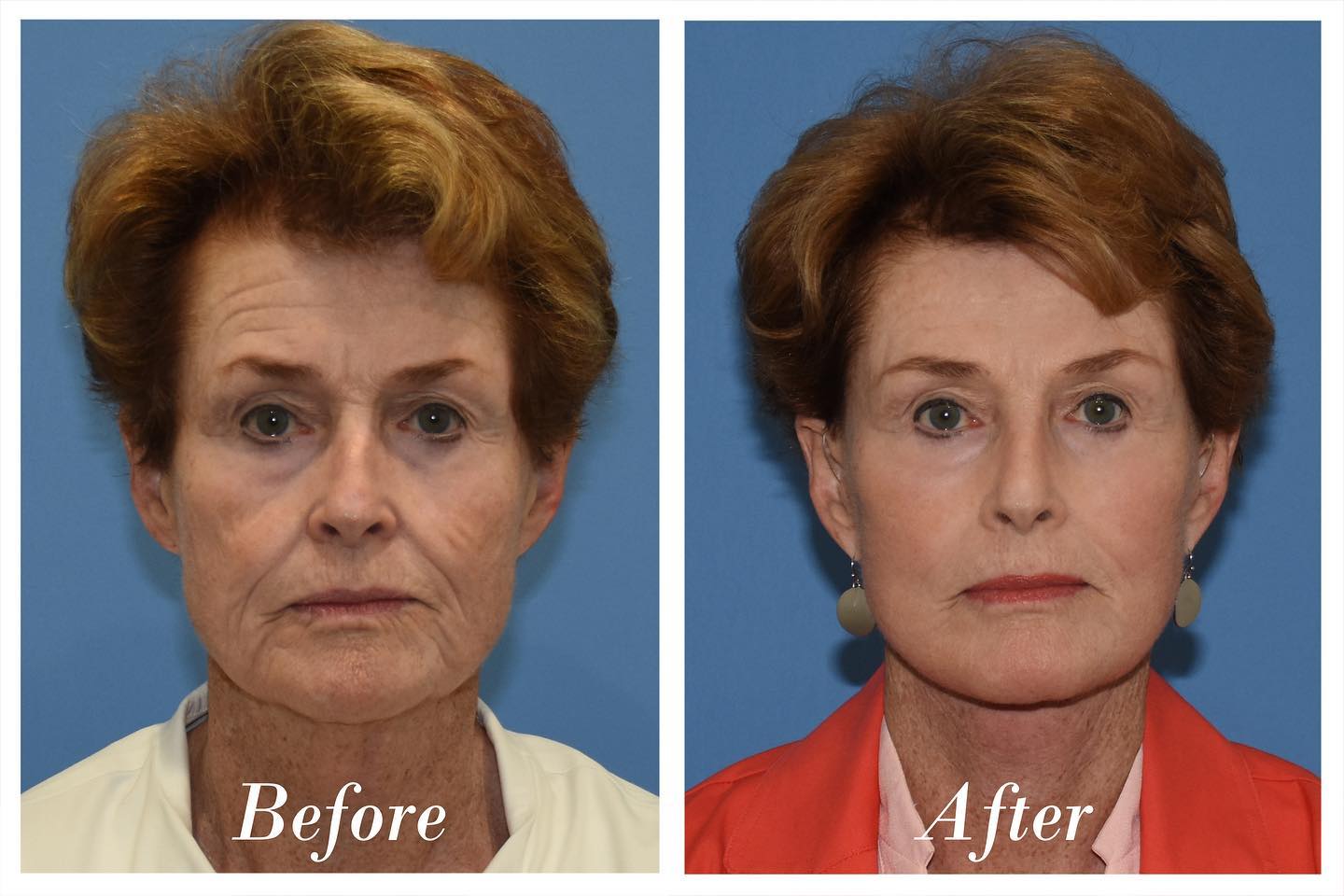 C02 Laser Before & After Image