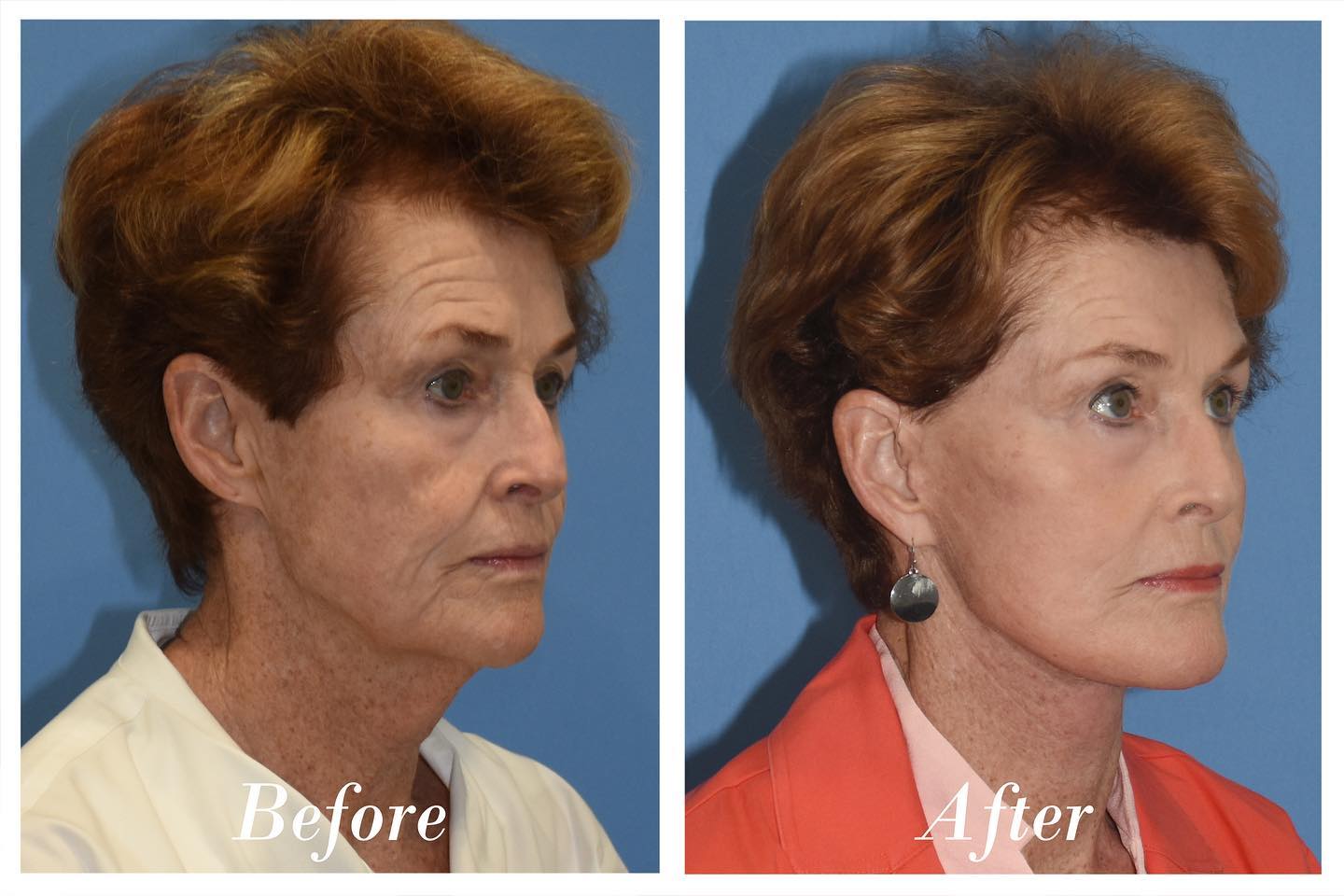 C02 Laser Before & After Image