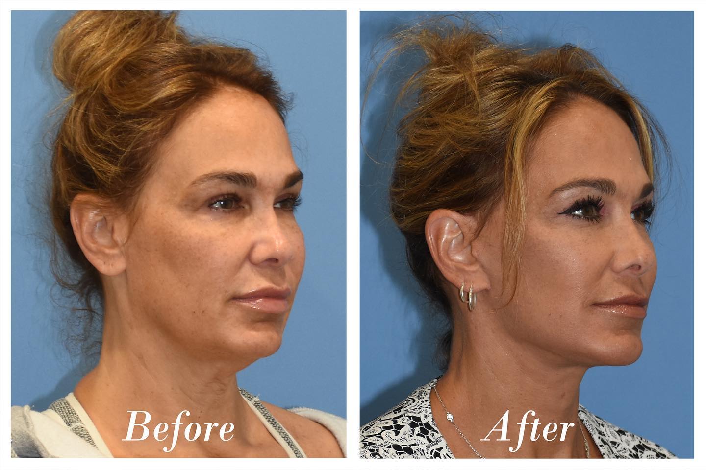 C02 Laser Before & After Image