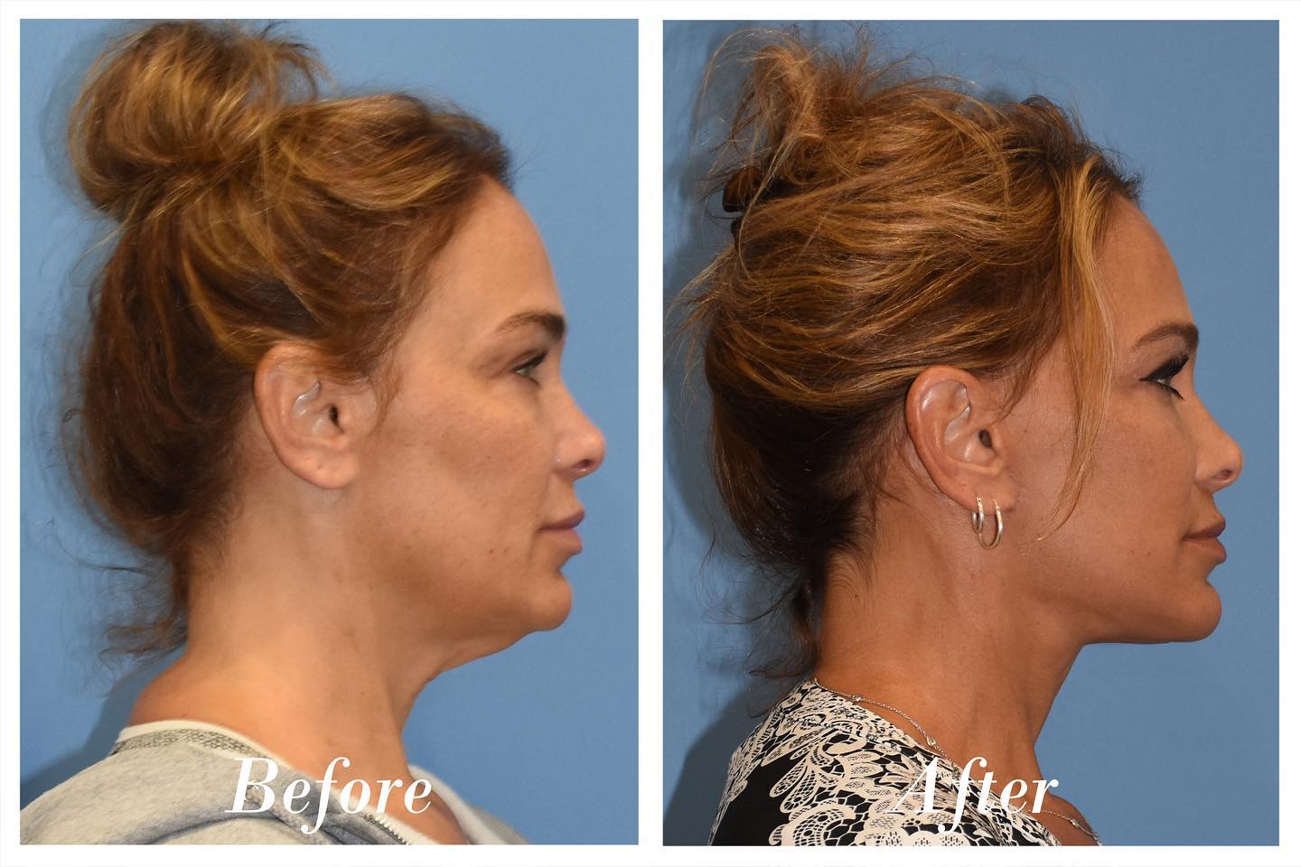 C02 Laser Before & After Image