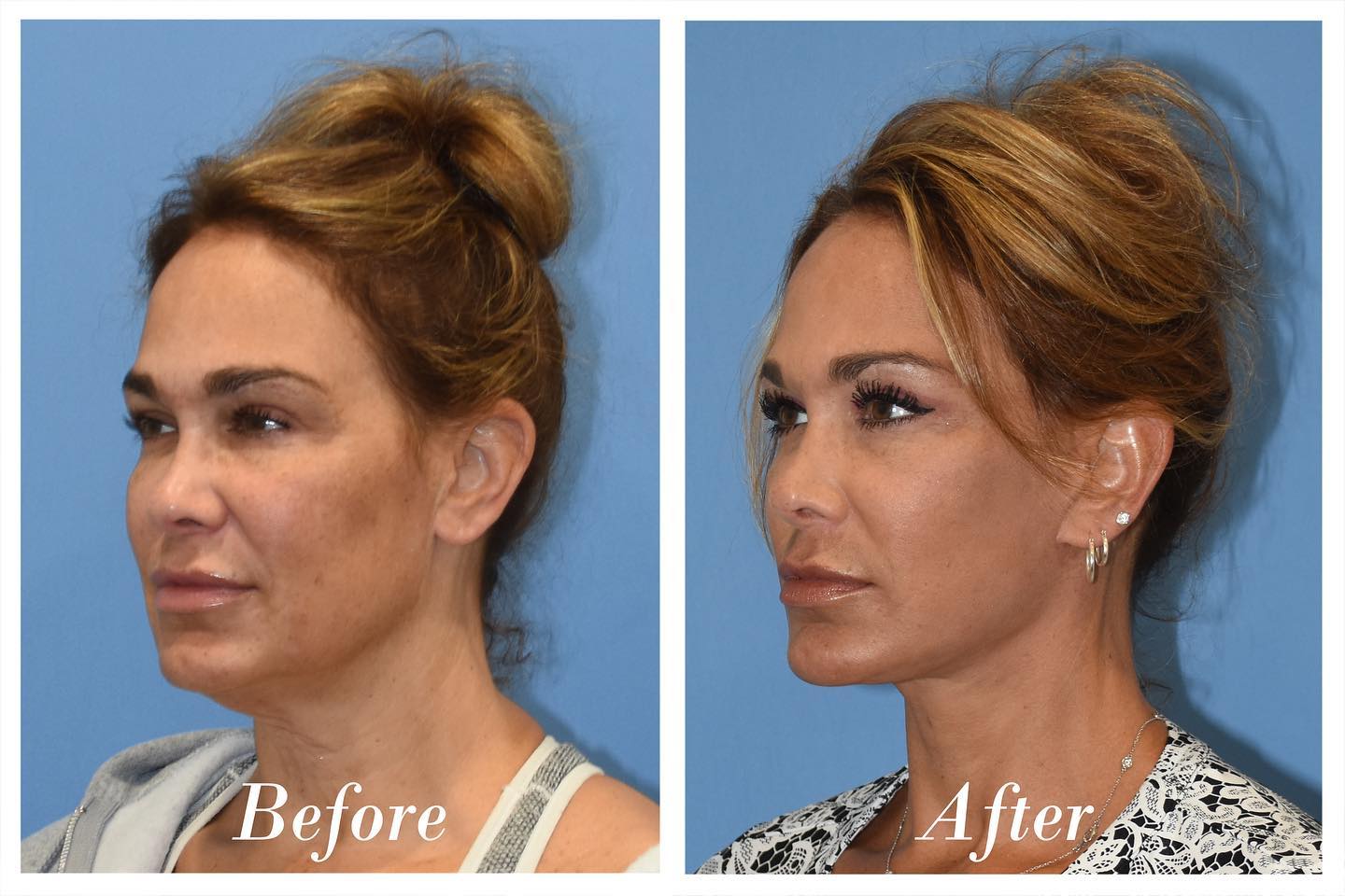 C02 Laser Before & After Image